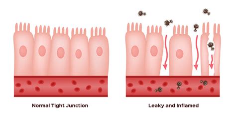 The connection between Autoimmune Diseases and Leaky Gut - AutoImmunee