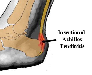 Pin on Foot Exercise, Injuries & Treatment