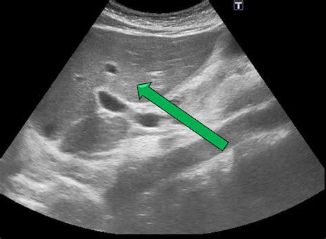 The abdominal ultrasonography showed slightly enlarged liver... | Download Scientific Diagram