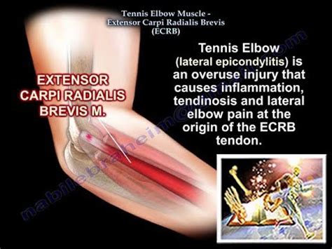 Tennis Elbow, Extensor Carpi Radialis Brevis, Everything You Need To Know - Dr. Nabil Ebraheim ...