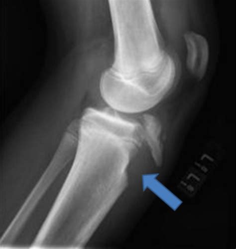 Patellar Tendon Rupture