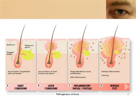 acne vulgaris