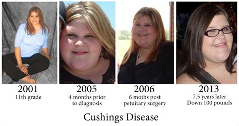 A Little Less Mommy: Cushing's Disease