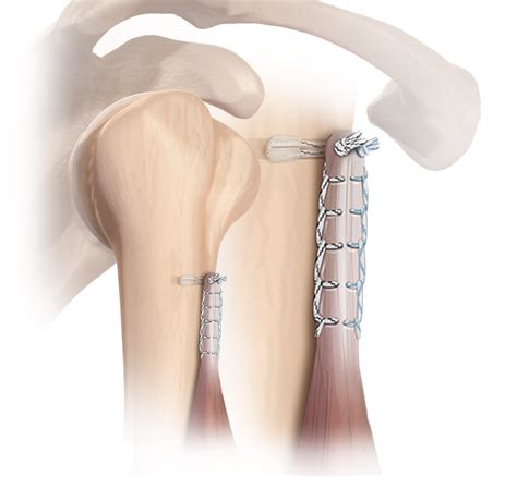 Arthrex - FiberTak® Biceps Tenodesis