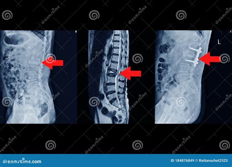 Burst Fracture At Lumbar Spine Stock Image | CartoonDealer.com #40239001