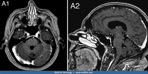 Clippers Syndrome - Case 212 Chronic Lymphocytic Inflammation With ...