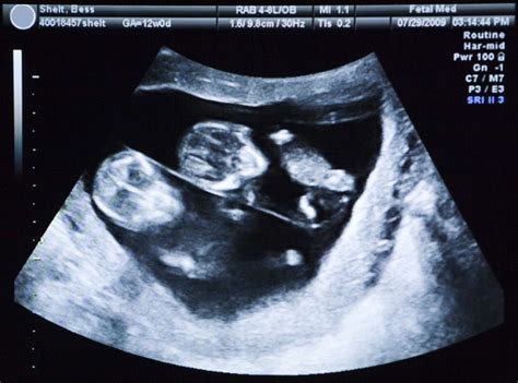 9 Week Ultrasound Identical Twins