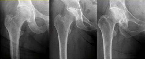 Examples fort the three types of the Dorr classification (left: type A;... | Download Scientific ...