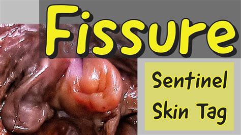 FISSURE & Sentinel skin Tag - TREATMENT - YouTube