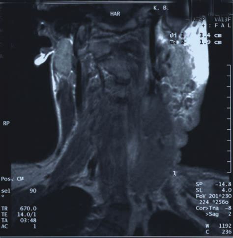 MRI scan of MPNST in the left jugular carotid space. | Download Scientific Diagram