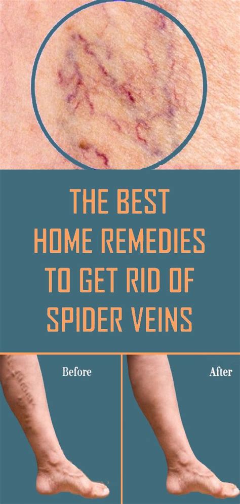 The Best Home Remedies to Get Rid of Spider Veins | Wellness Webs