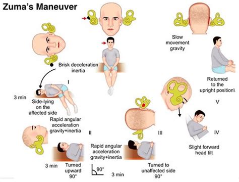 Lateral Canal BPPV treated with the Zuma maneuver