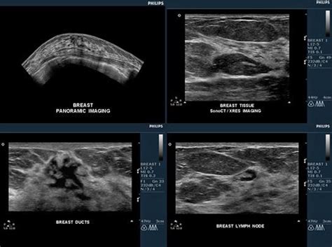 Breast Ultrasound * New York Medical Imaging * Diagnostic Radiology Manhattan NY