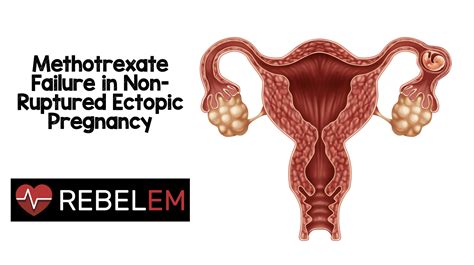 Methotrexate Failure in Non-Ruptured Ectopic Pregnancy - REBEL EM - Emergency Medicine Blog