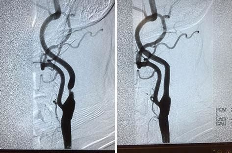 Before & After: Carotid Artery Stent - Riverside, CA