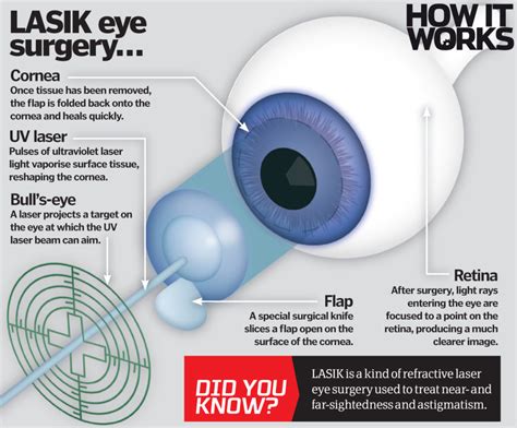 How does laser eye surgery work? – How It Works