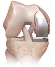 Common Problems after Knee Replacement - Knee Pain Explained