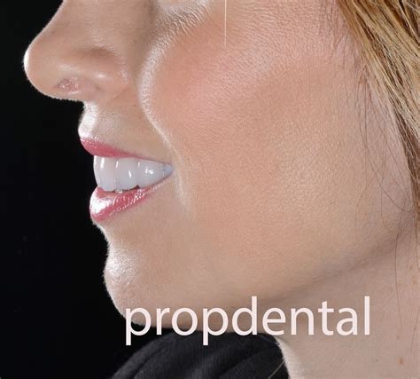 ¿Qué cuidados necesitan los implantes dentales? Propdental