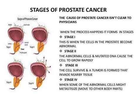 What Are The Four Stages Of Prostate Cancer - CancerWalls