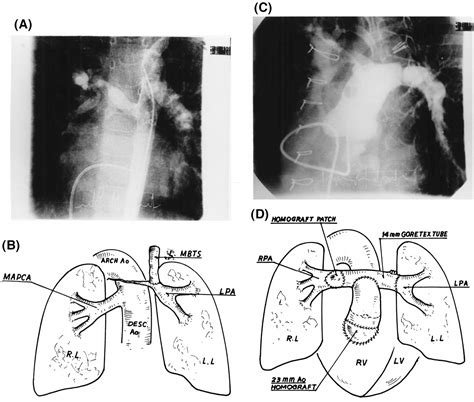 Figure 2 from Median sternotomy single stage complete unifocalization ...