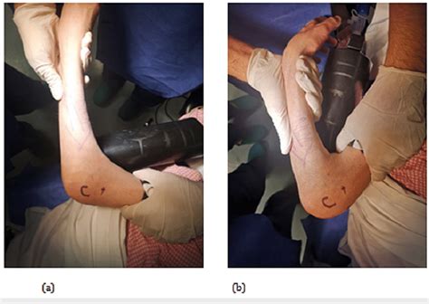 Preoperative assessment ranges of motion (ROM). Elbow extension (a) and ...