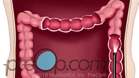 Lower Endoscopy - Lower GI - Colonoscopy Procedure - PreOp® Patient Education - YouTube