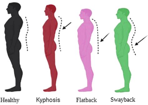 3 Deformities caused due to bad body postures. Healthy: normal body... | Download Scientific Diagram