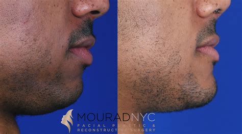 Before and After Sliding Genioplasty | Facial Plastic Surgeon