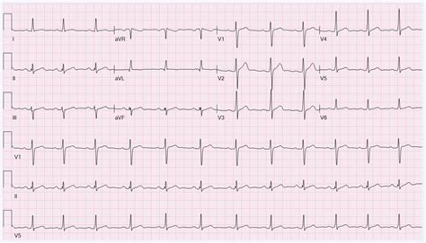 21-Year-Old Male With Transient Abnormal ECG - American College of Cardiology