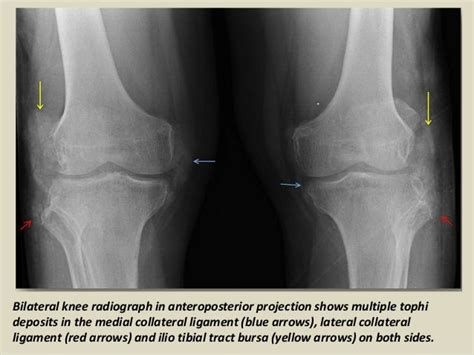 Presentation1.pptx, radiological imaging of gout disease.