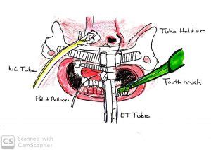 Oral Care during Intubation – Rachel's Site