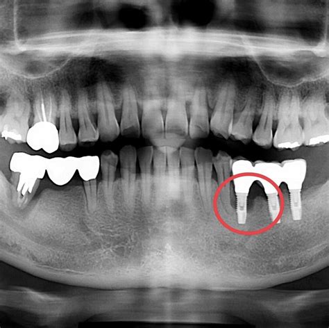 Dental Implant Specialist Honolulu HI Oahu | CAT® 3D Imaging