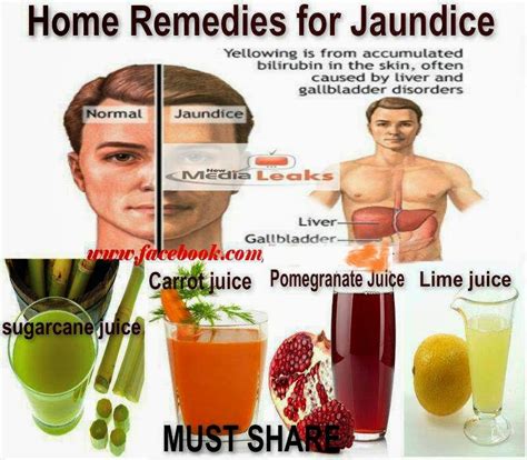 Jaundice - Health And Physical Fitness