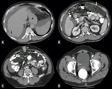 Peritoneal Carcinomatosis Primary Peritoneal Cancer C - vrogue.co