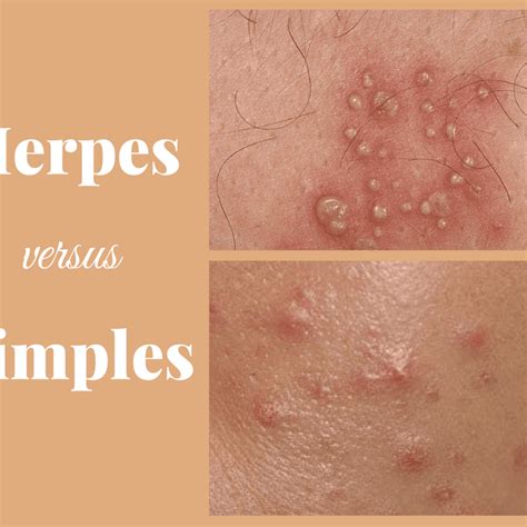 Ingrown Hair Vs Herpes