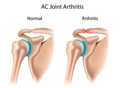 Shoulder Acromioclavicular (AC) joint osteoarthritis: Orthopedic Center for Sports Medicine ...