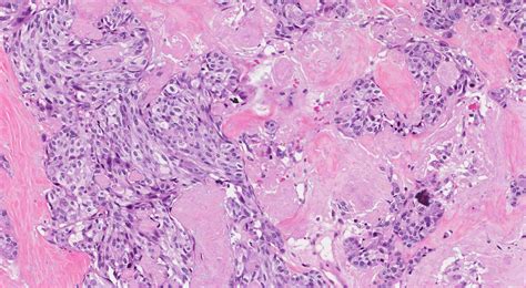 Medullary thyroid carcinoma | MyPathologyReport.ca