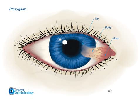 Pterygium Surgery Sunshine Coast - Central Ophthalmology