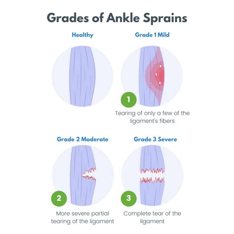 Ankle Sprain Recovery Time - The Frankel Foot & Ankle Center