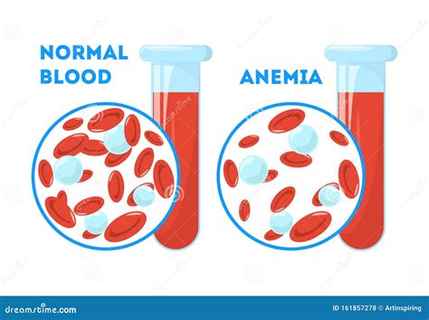 The Anemia Symptoms. Normal and Anemia Blood Stock Vector - Illustration of icon, hemoglobin ...