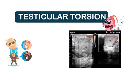 TESTICULAR TORSION | CAUSES OF TESTICULAR TORSION , SYMPTOMS ,DIAGNOSIS ...