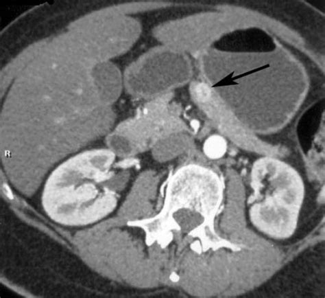 Multi–Detector Row CT of Pancreatic Islet Cell Tumors | RadioGraphics