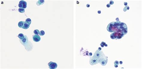 Atypical Urothelial Cells (AUC) | Basicmedical Key