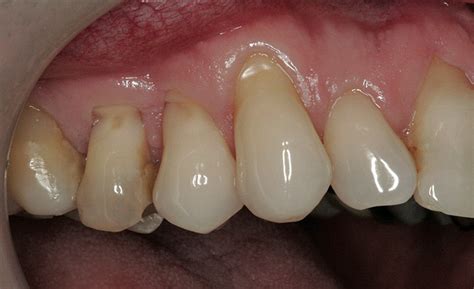 Tooth Abfraction Treatment