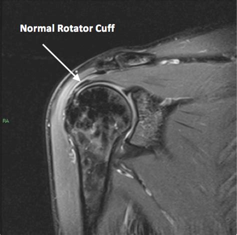 SHOULDER MRI - Upper West Side, Columbus Circle New York, NY