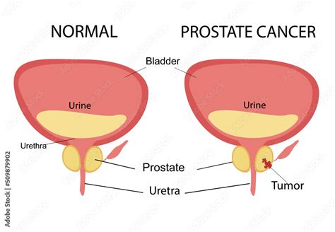 Vetor de Healthy prostate and prostate cancer. Illustration of male ...