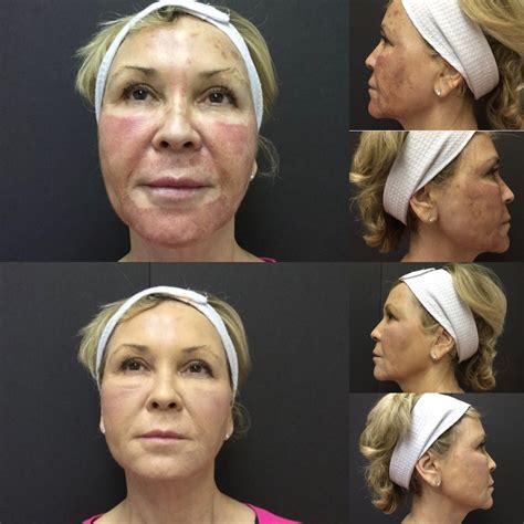 SkinCeuticals Advanced Corrective Peel – Cynthia Golomb, MD | Dermatology Boutique