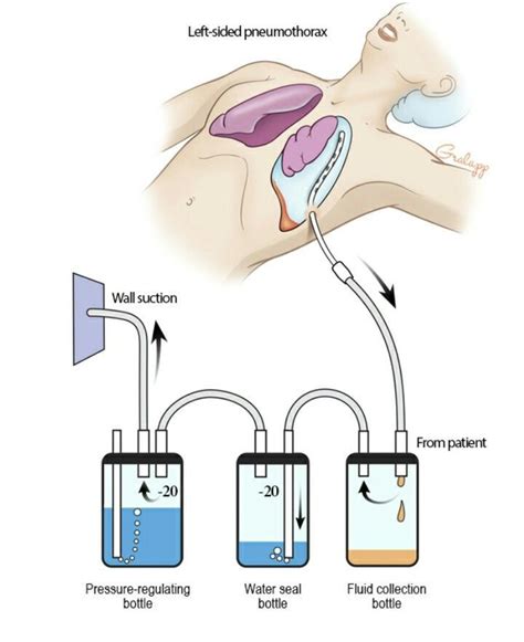 Atrium Chest Tube Drainage System Bubbling at David Miller blog