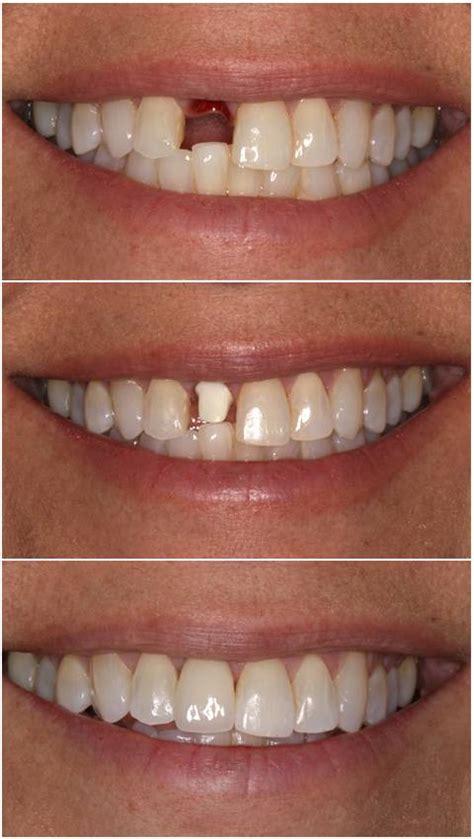 Implantes Dentales preguntas y respuestas - Odontología Especializada Medellín