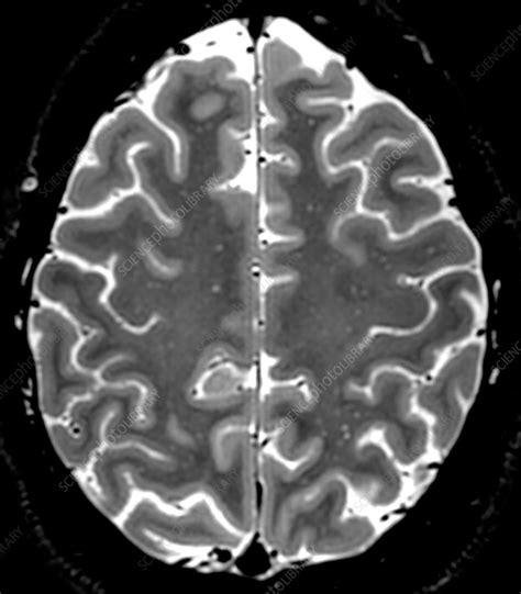 Normal Axial T2 Brain - Stock Image - C039/3768 - Science Photo Library